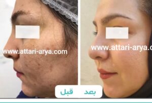 قبل و بعد استفاده از کرم وایت رز پلاس